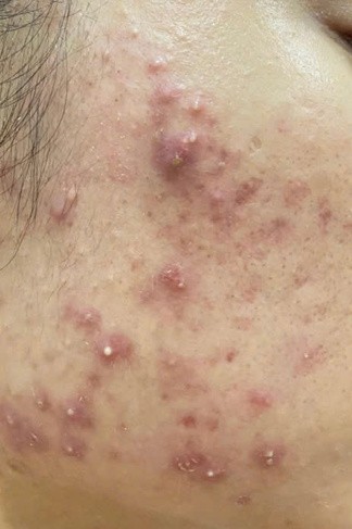 Trước liệu trình