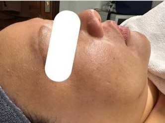 Trước liệu trình
