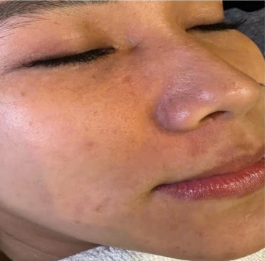 Trước liệu trình