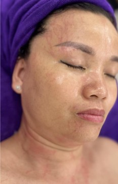 Sau liệu trình — Trước và sau Pro Alpha Peel