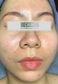 Sau liệu trình — Sau 1 lần Prozyme + Enzyme