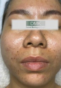 Trước liệu trình